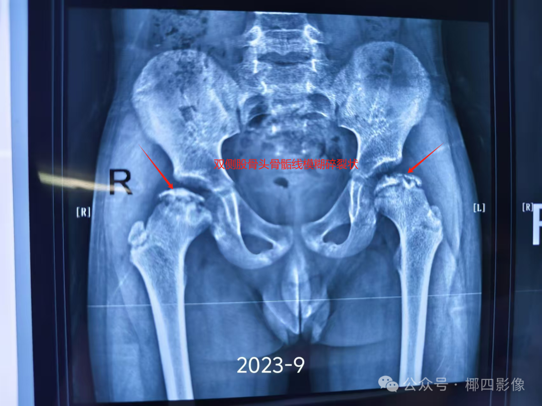 股骨头坏死可以自愈吗