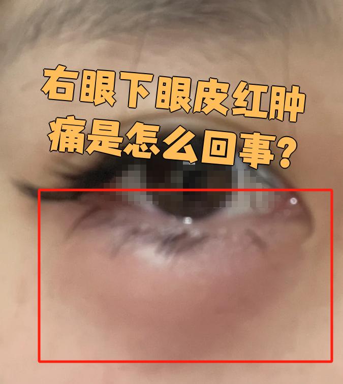 眼皮红是怎么回事