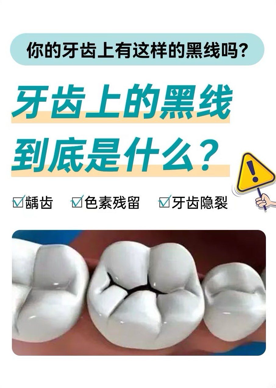 牙齿上有黑点怎么去除