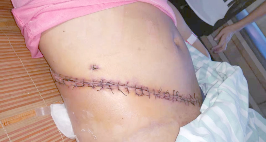 盆骨骨折要多久能下床