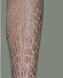 鱼鳞病能治愈吗