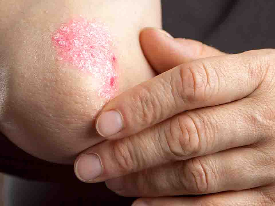 鱼鳞病能治愈吗