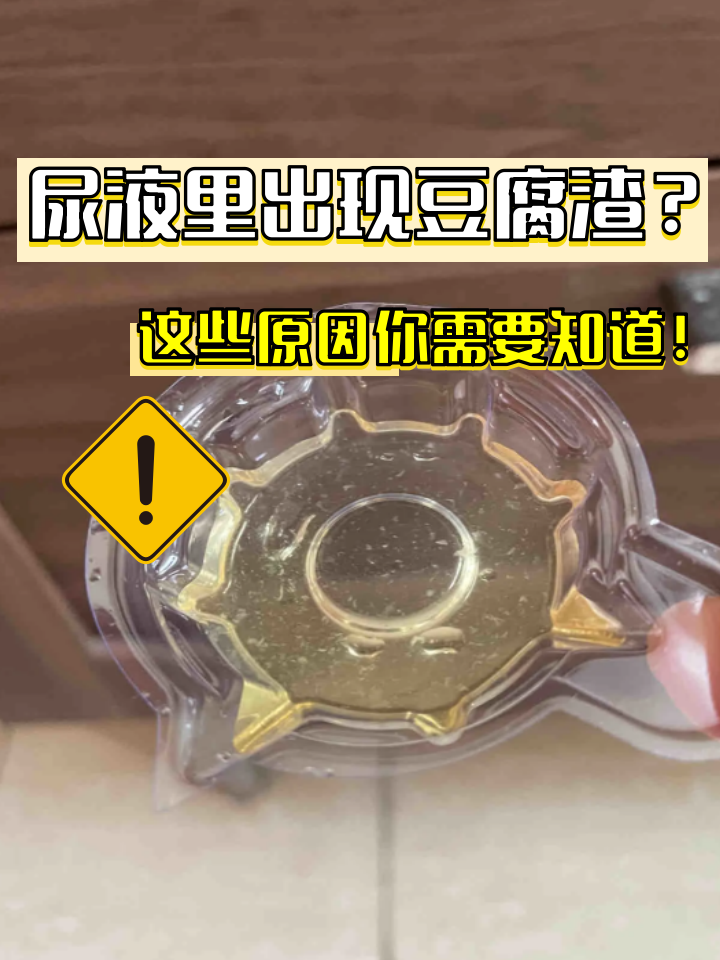 尿里有白色沉淀物