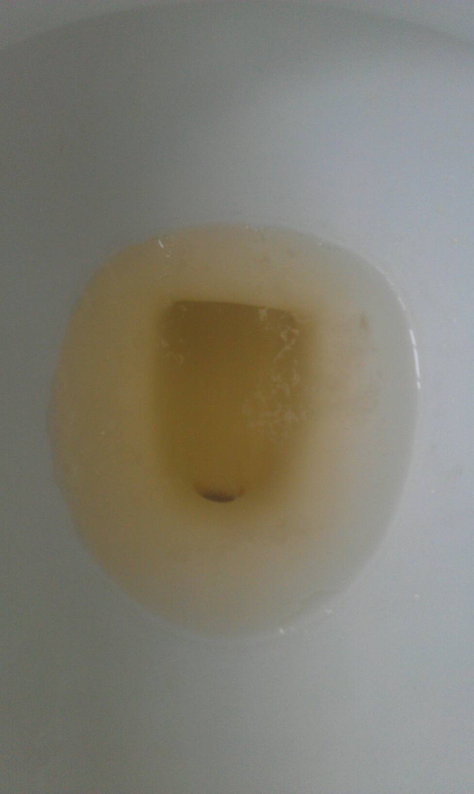 尿里有白色沉淀物