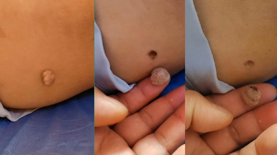 发现肛门处一凸肉,不痛不痒,