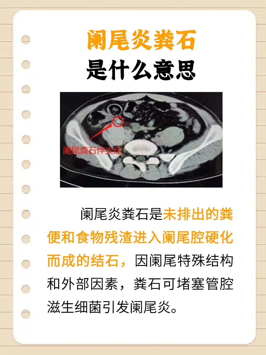 急性阑尾炎怎么造成的