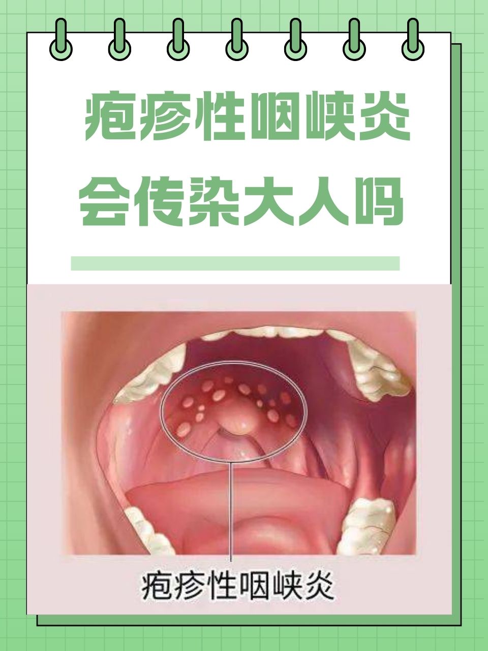 急性咽炎是什么病症