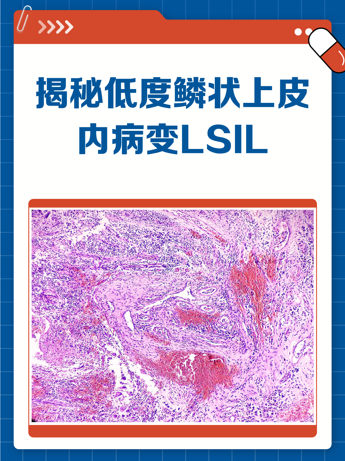 低级别鳞状上皮病变LSIL怎么回事