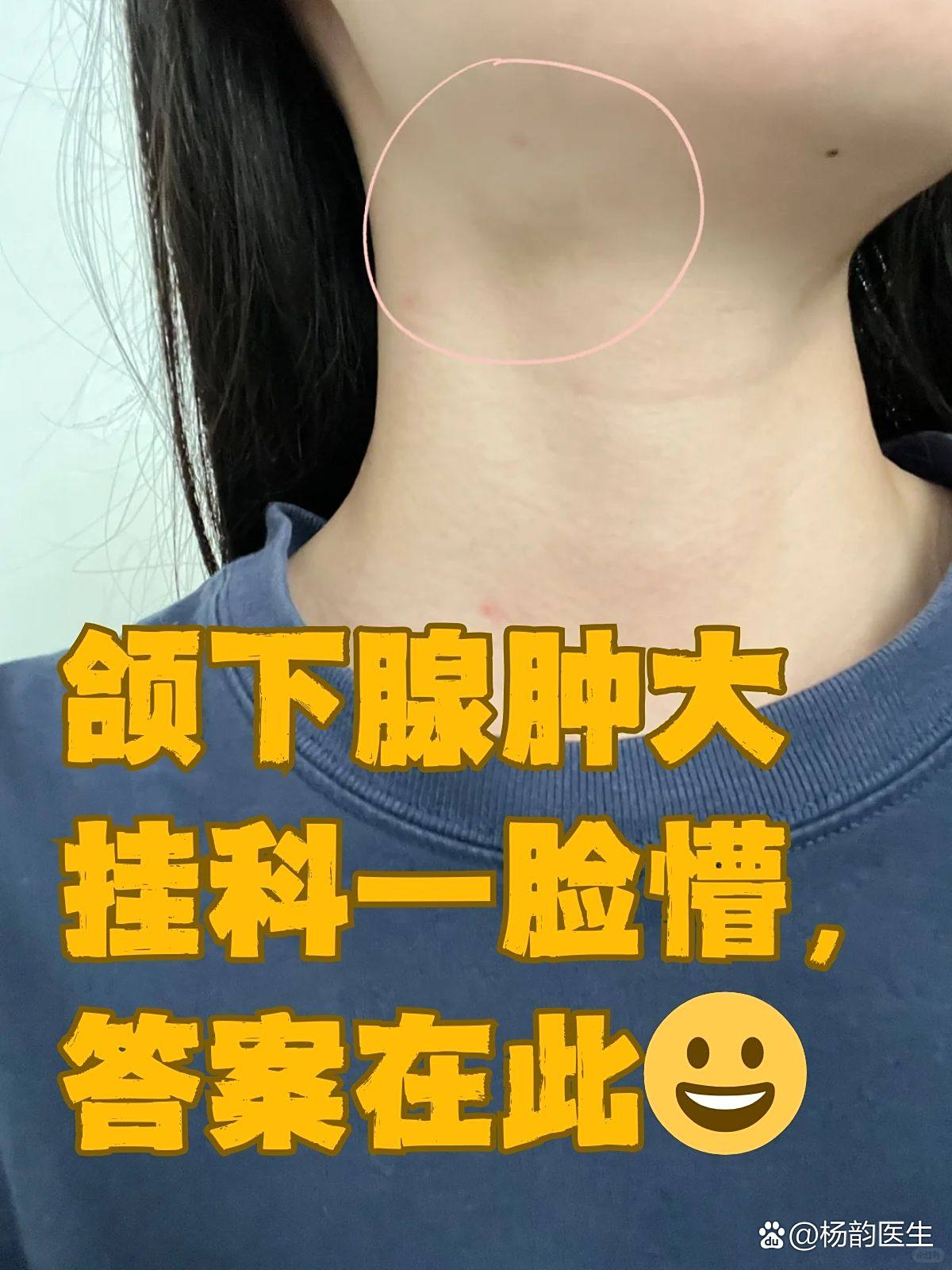 颌下淋巴结肿大怎么回事