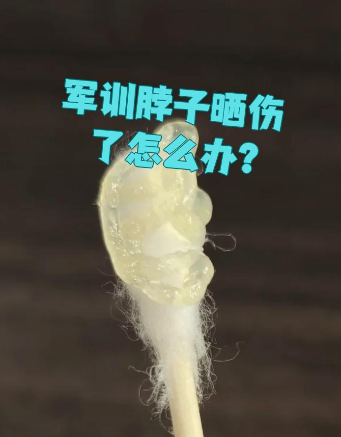 脖子晒伤怎么办?