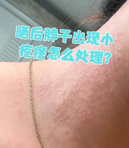 脖子晒伤怎么办?