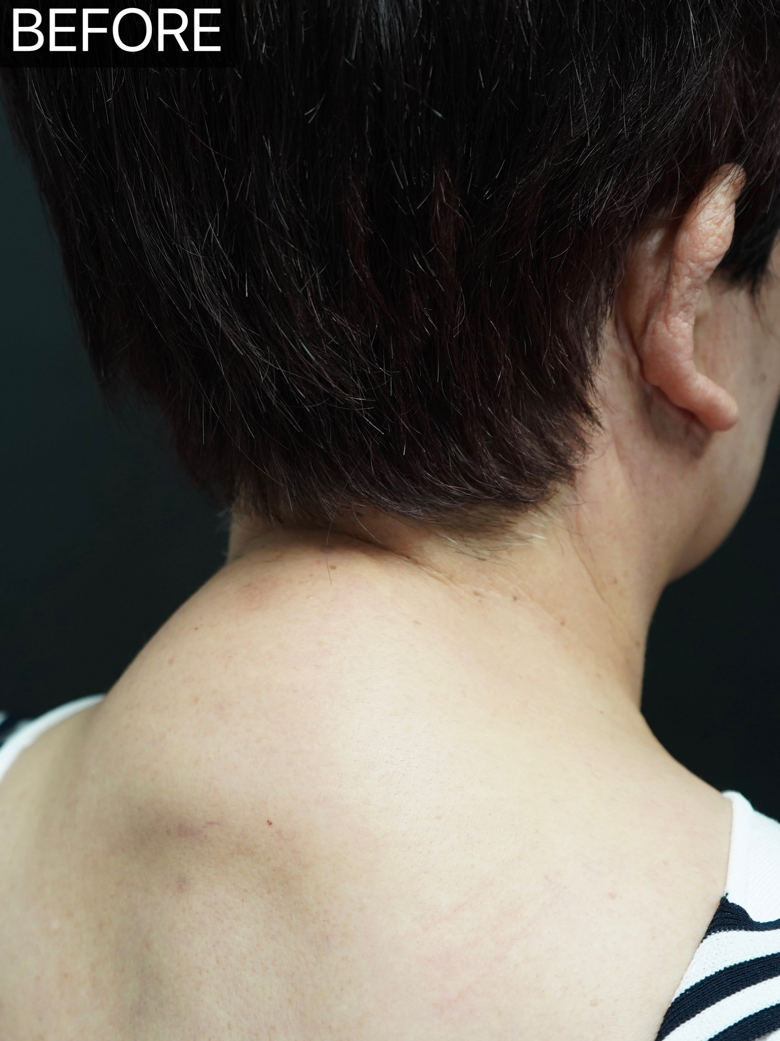 颈椎骨质增生有什么症状表现