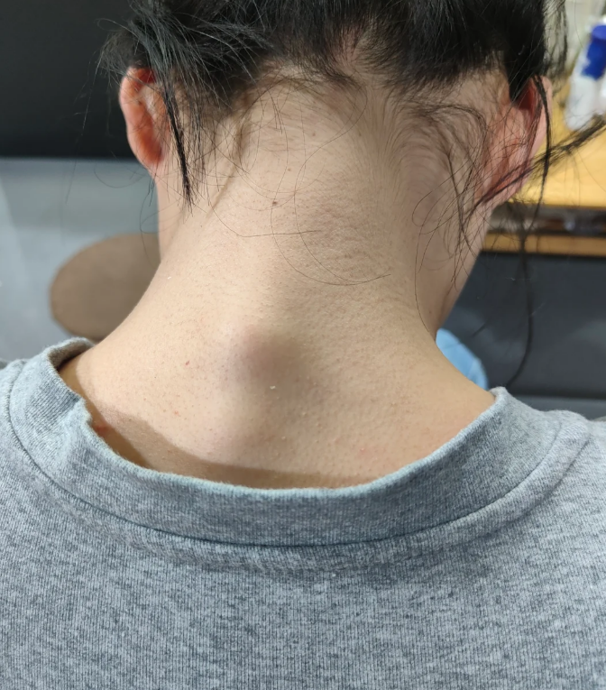 颈椎骨质增生有什么症状表现