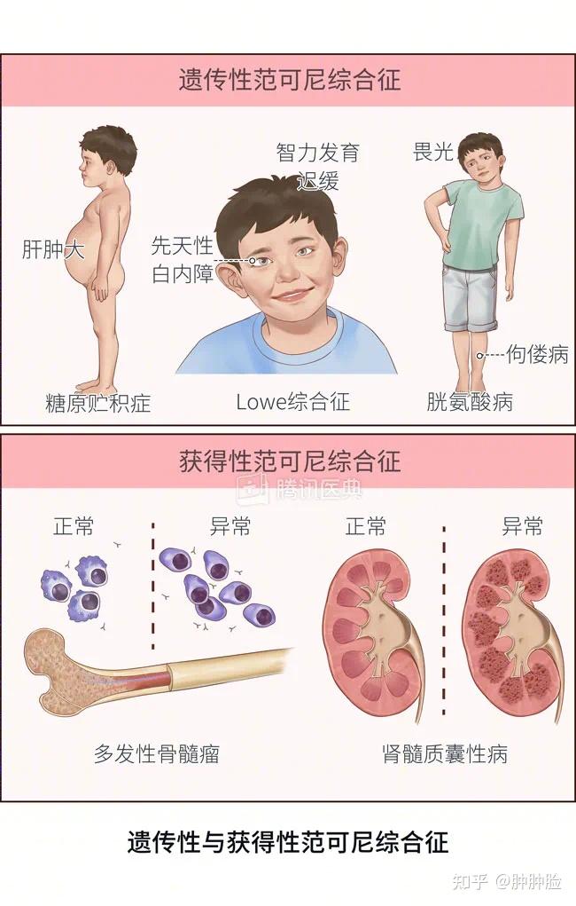 什么是骨髓增生异常综合征?