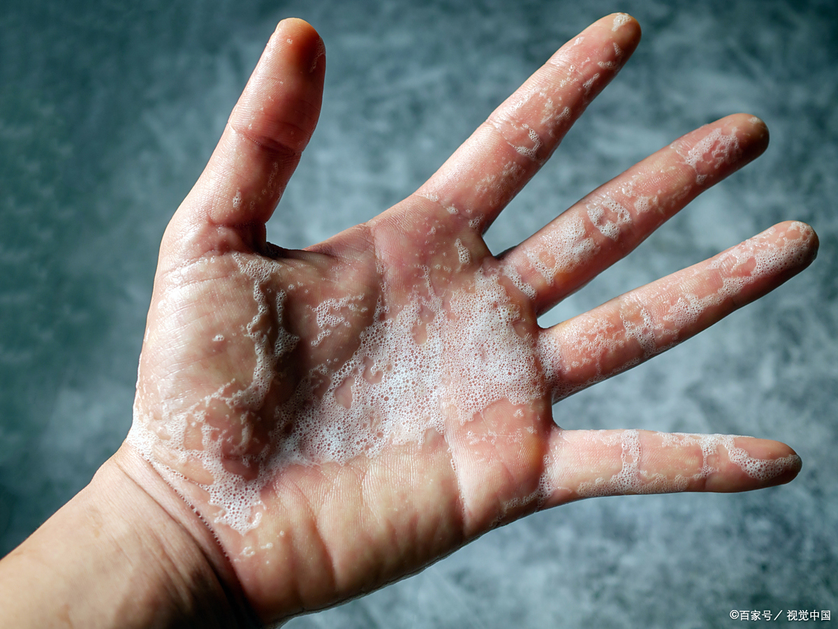 儿童手指脱皮怎么回事