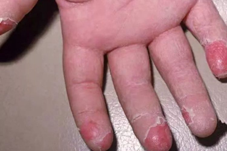 儿童手指脱皮怎么回事