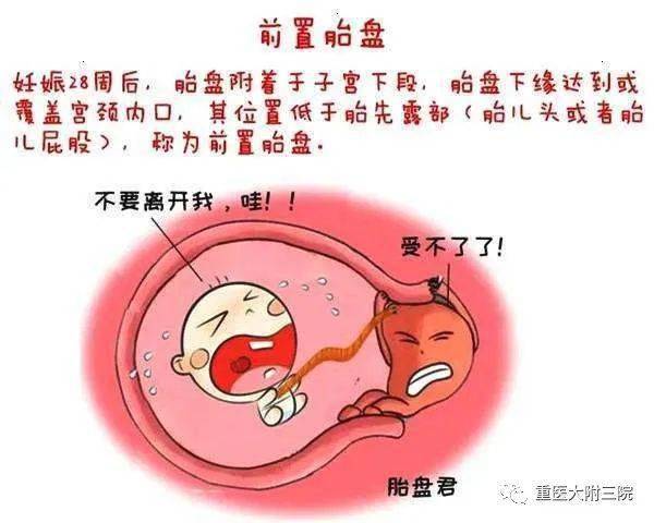 前置胎盘是什么引起的