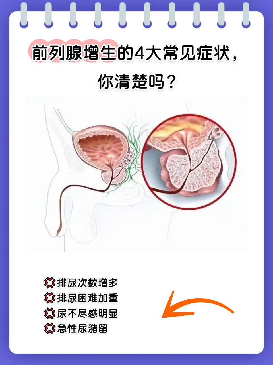 前列腺增生是怎么造成的?