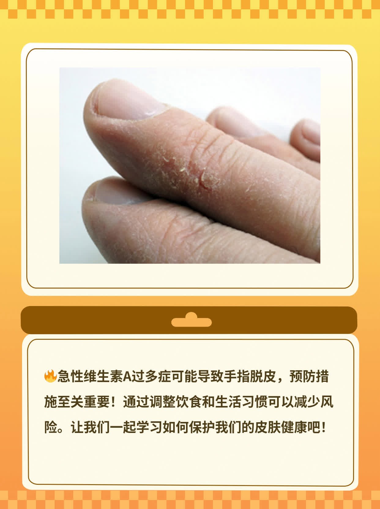 手指脱皮是怎么原因