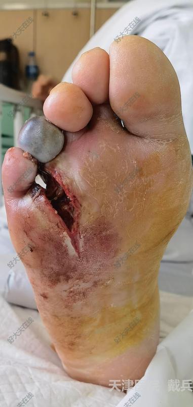 糖尿病可以手术治疗吗?