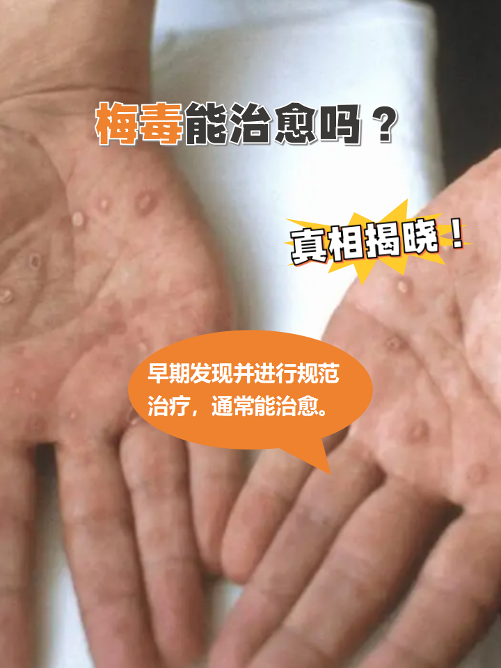 女性得了梅毒可以彻底治愈吗?