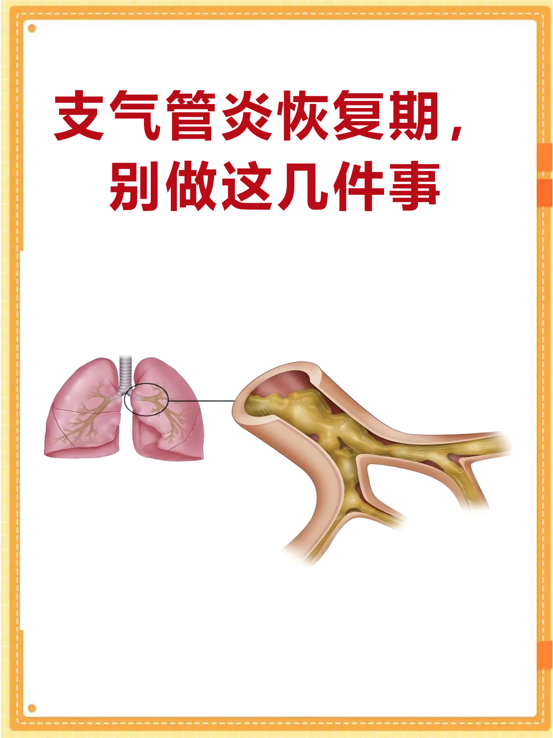 慢性支气管炎的早期症状?