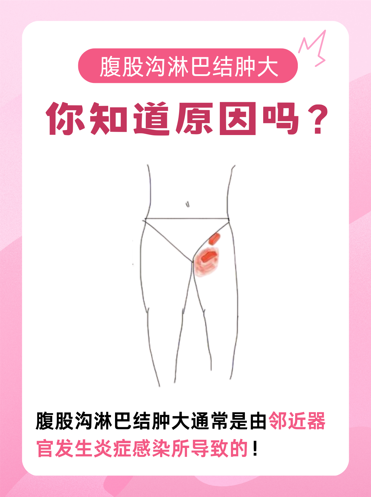 淋巴结发炎是什么原因引起的