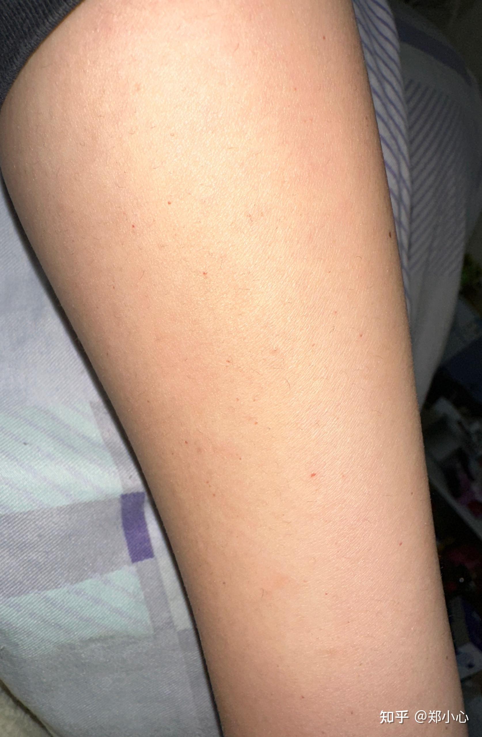 胳膊上长了很多小血点