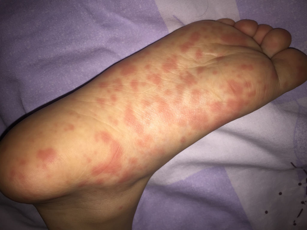 宝宝脚心手心发烫,怎么回事.