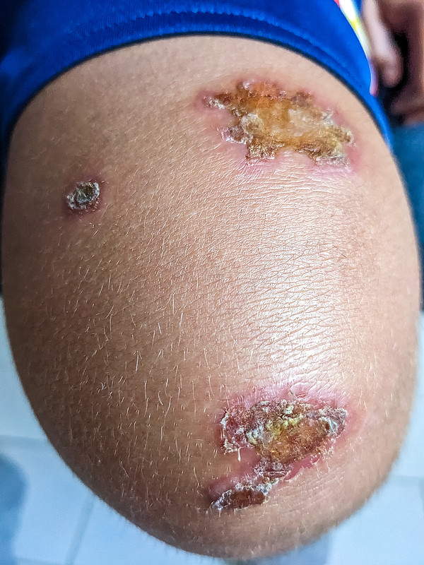 急性化脓性骨髓炎的症状