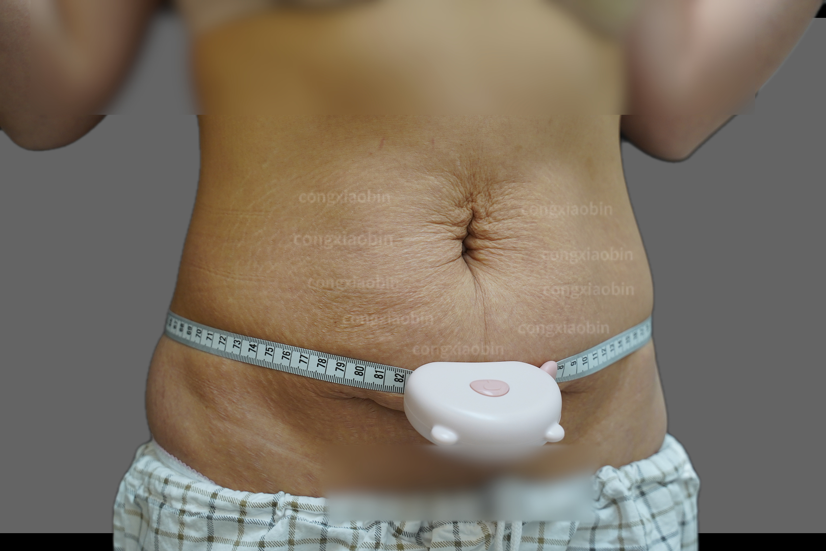 腹中线明显,太影响美观