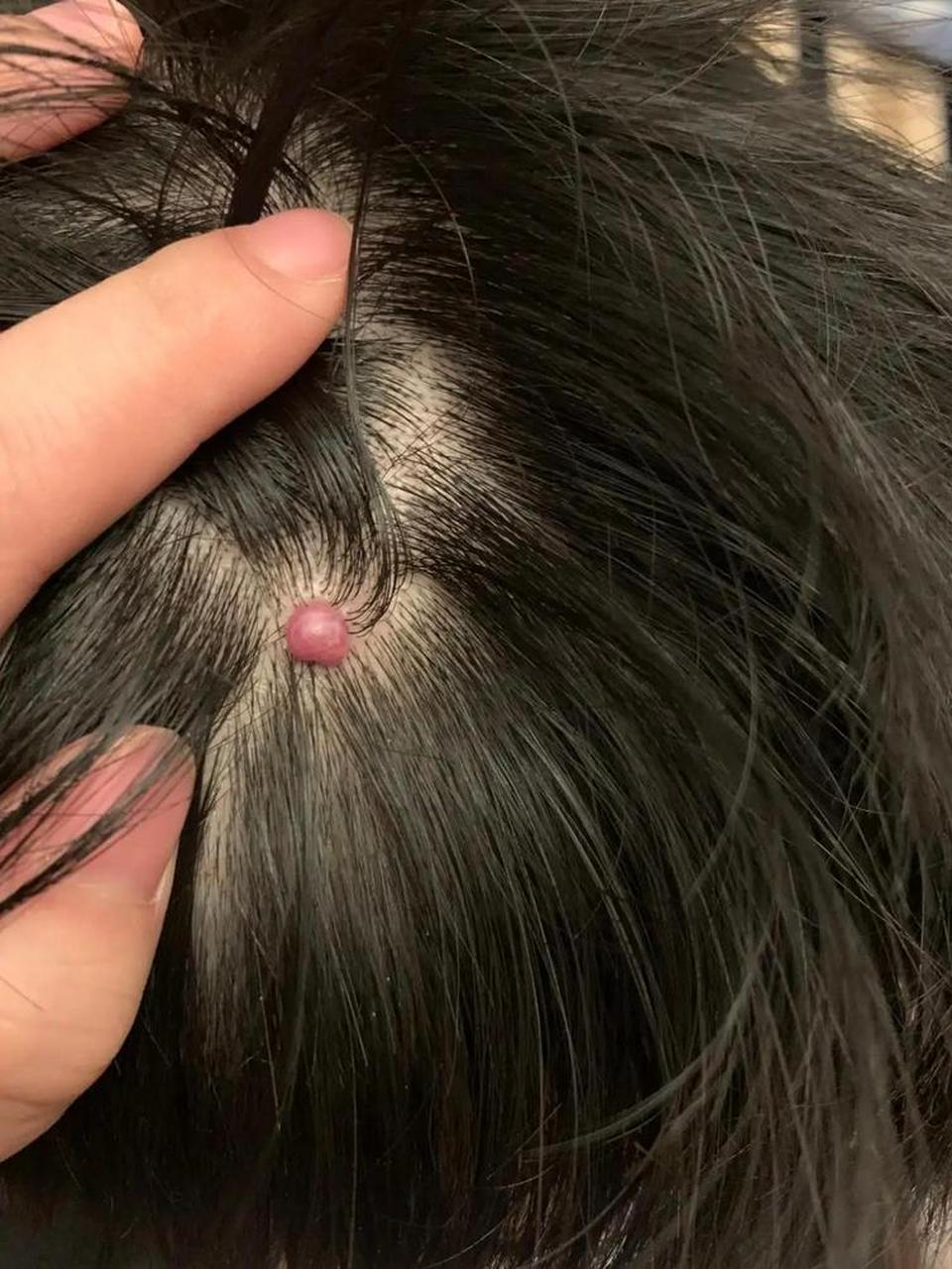 头上长个肉瘤,不疼不痒