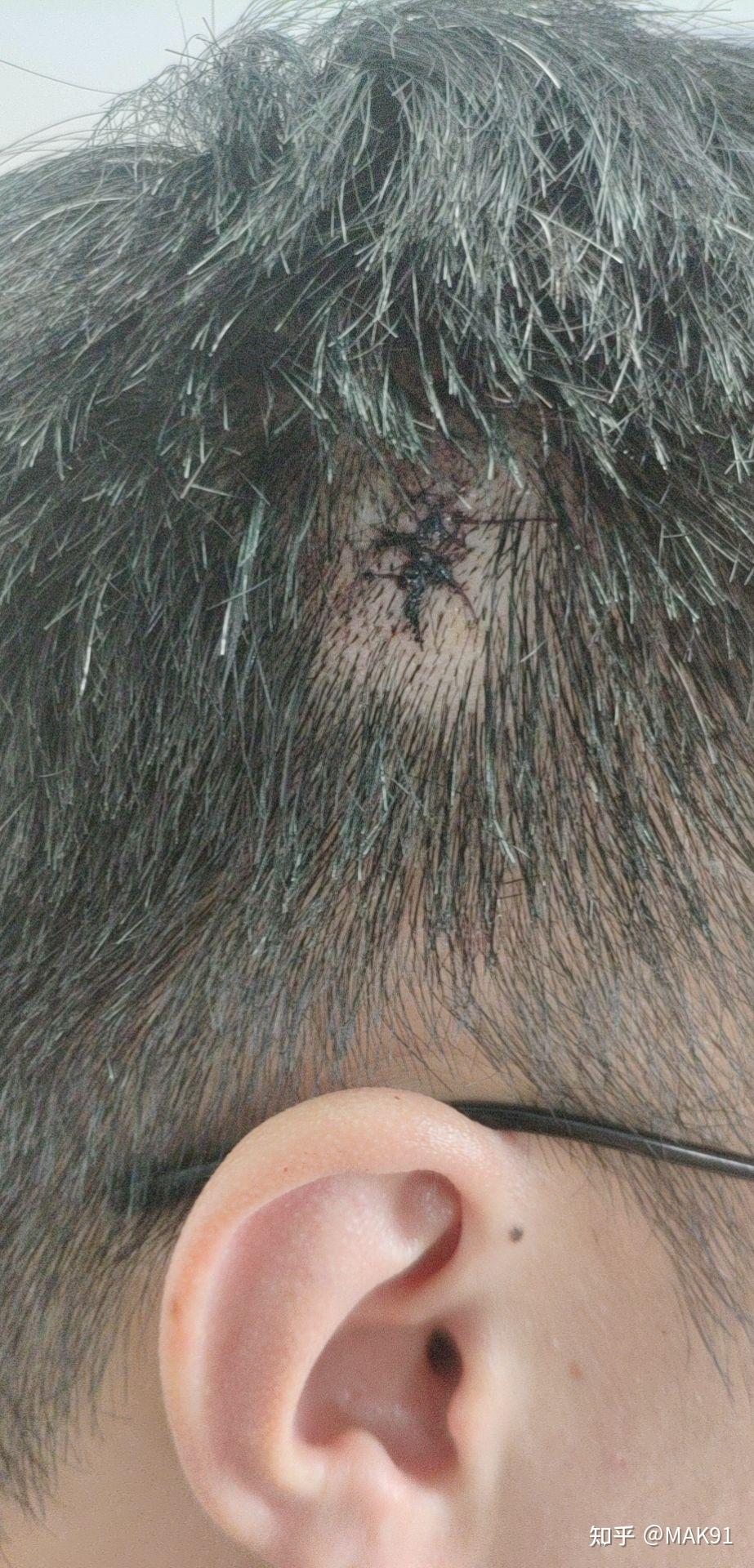 头上长个肉瘤,不疼不痒