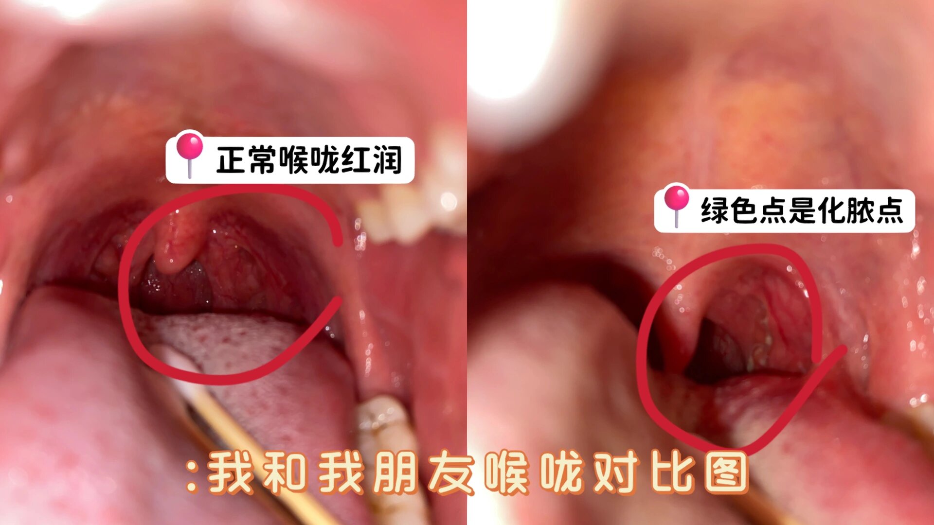 嗓子下面感觉有东西堵着