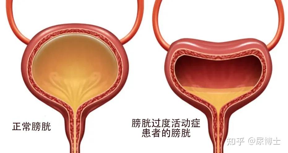 神经源性膀胱症状