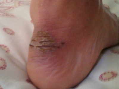 脚上生冻疮了怎么办