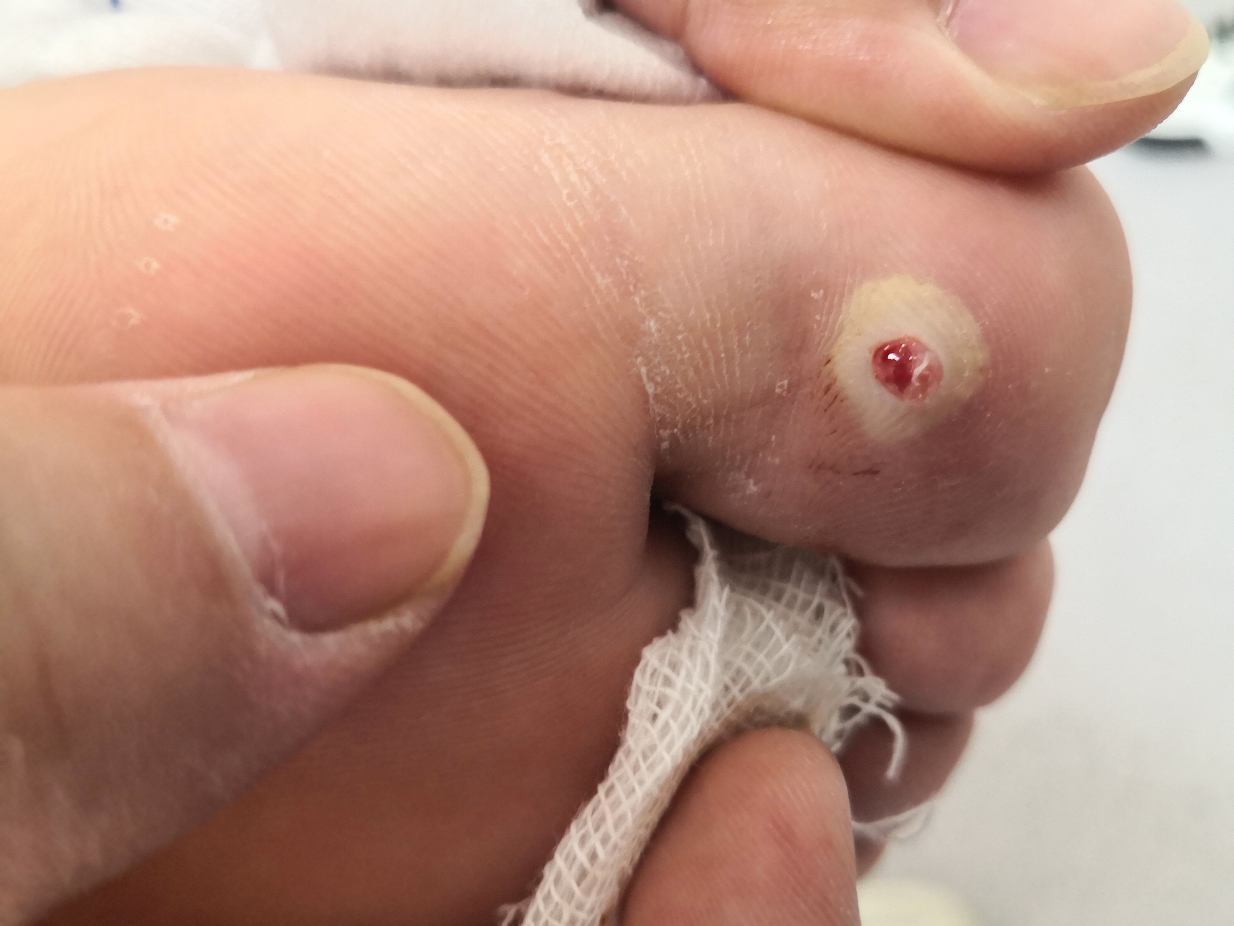 脚趾缝里长了个硬疙瘩怎么回事