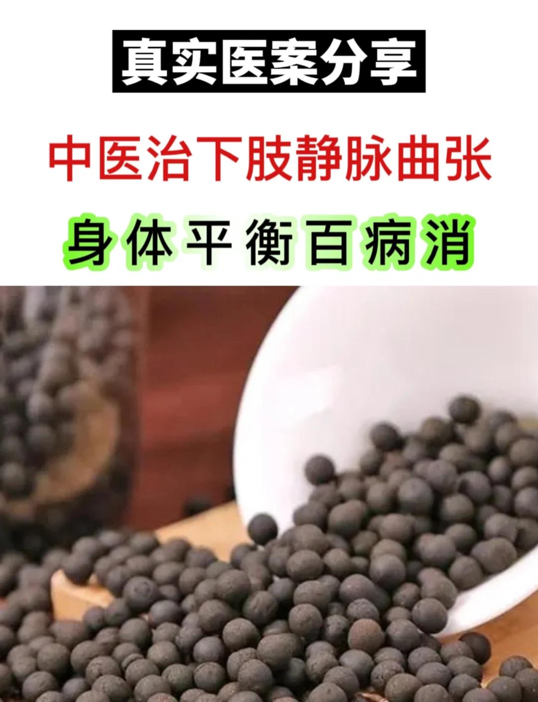 治疗静脉曲张的偏方有哪些