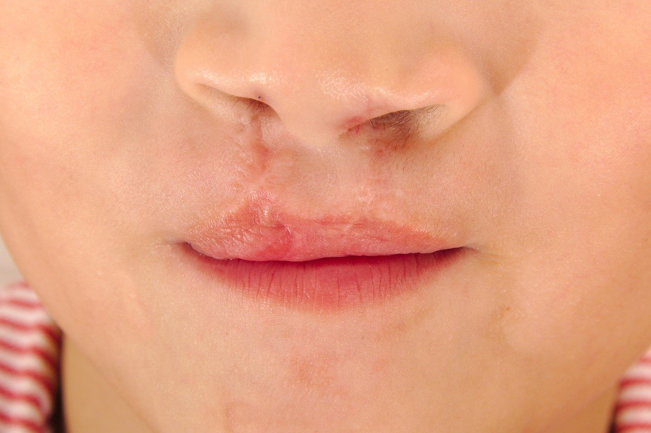 腭裂是什么样的?