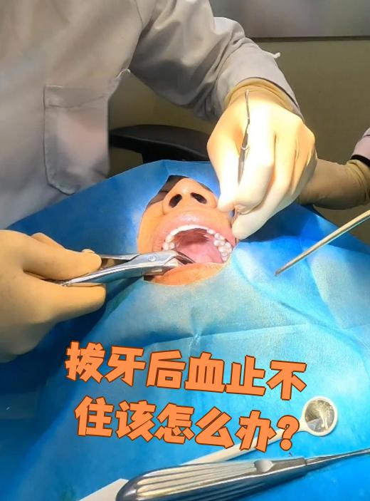 拔牙后出血不止怎么办