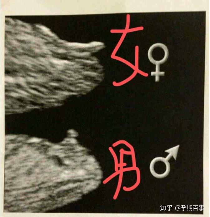 怀孕12周NT值多少正常