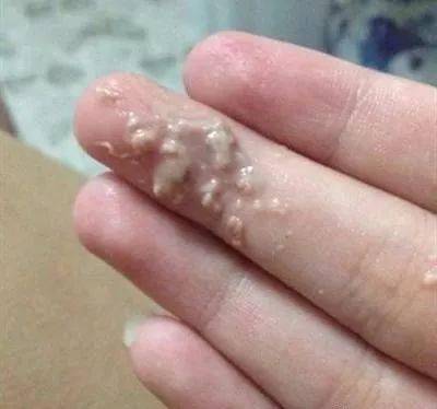 白色念珠菌阴道炎怎么回事