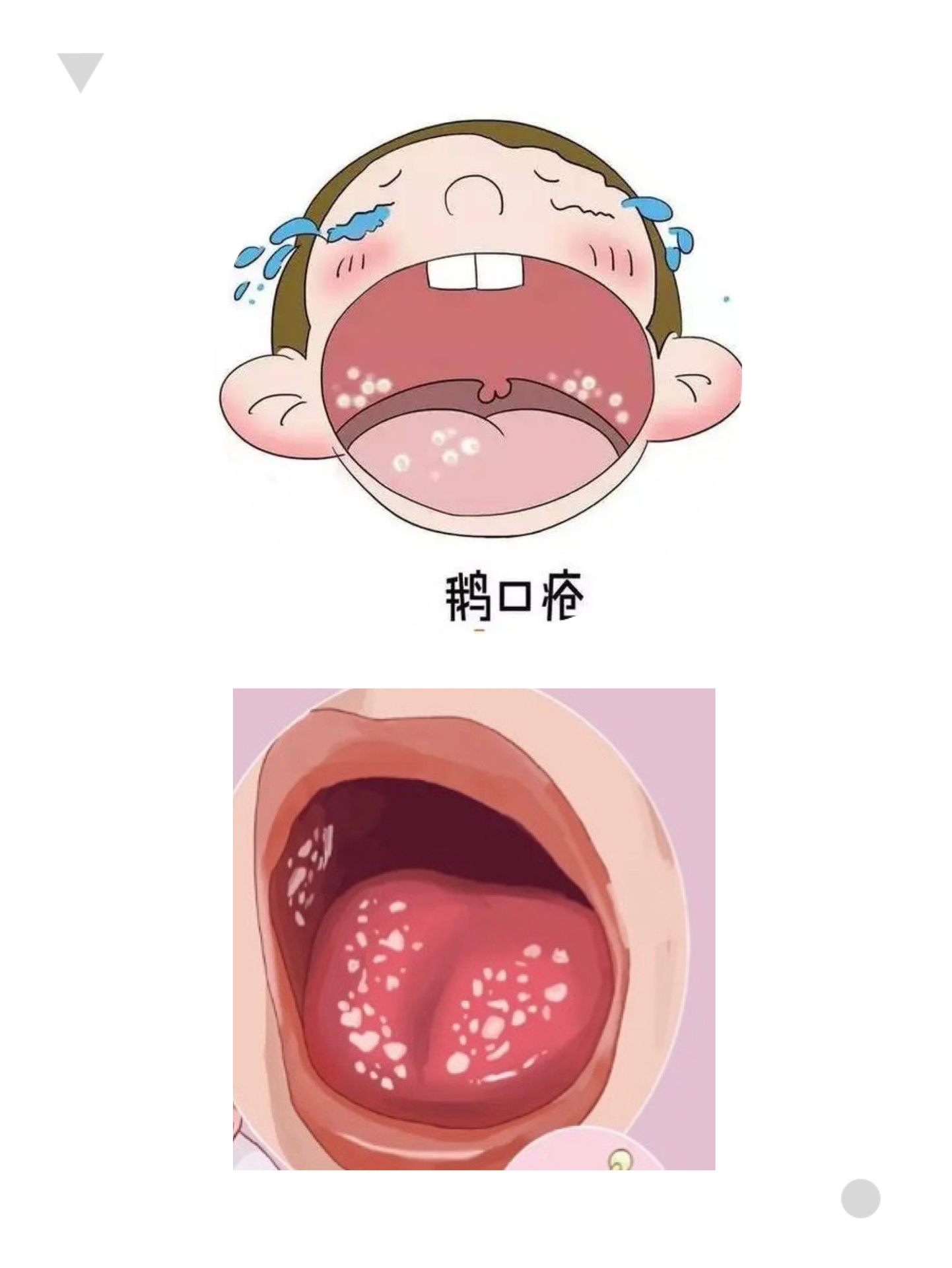 鹅口疮都有哪些症状