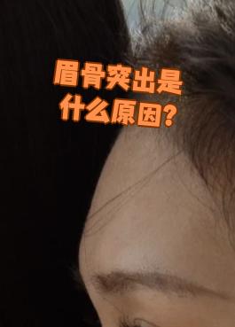 眉骨突出主要是哪方面原因
