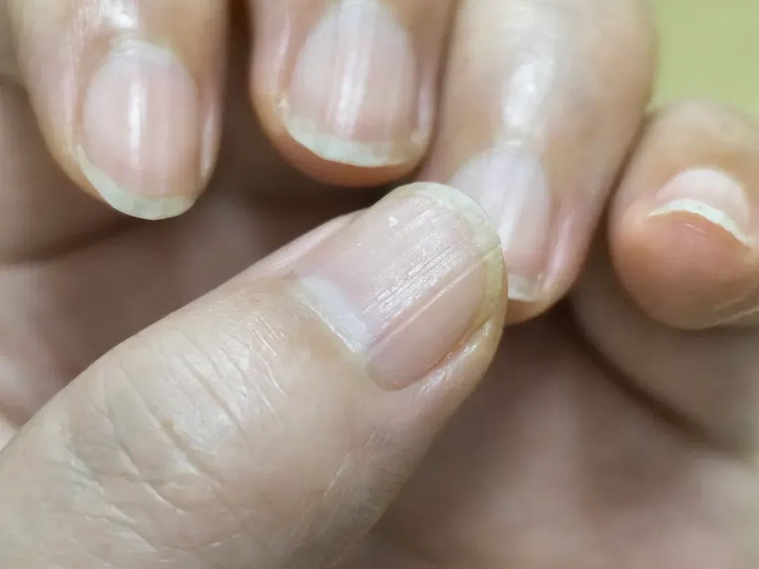 指甲上出现坑坑洼洼的,还有竖纹,怎么回事