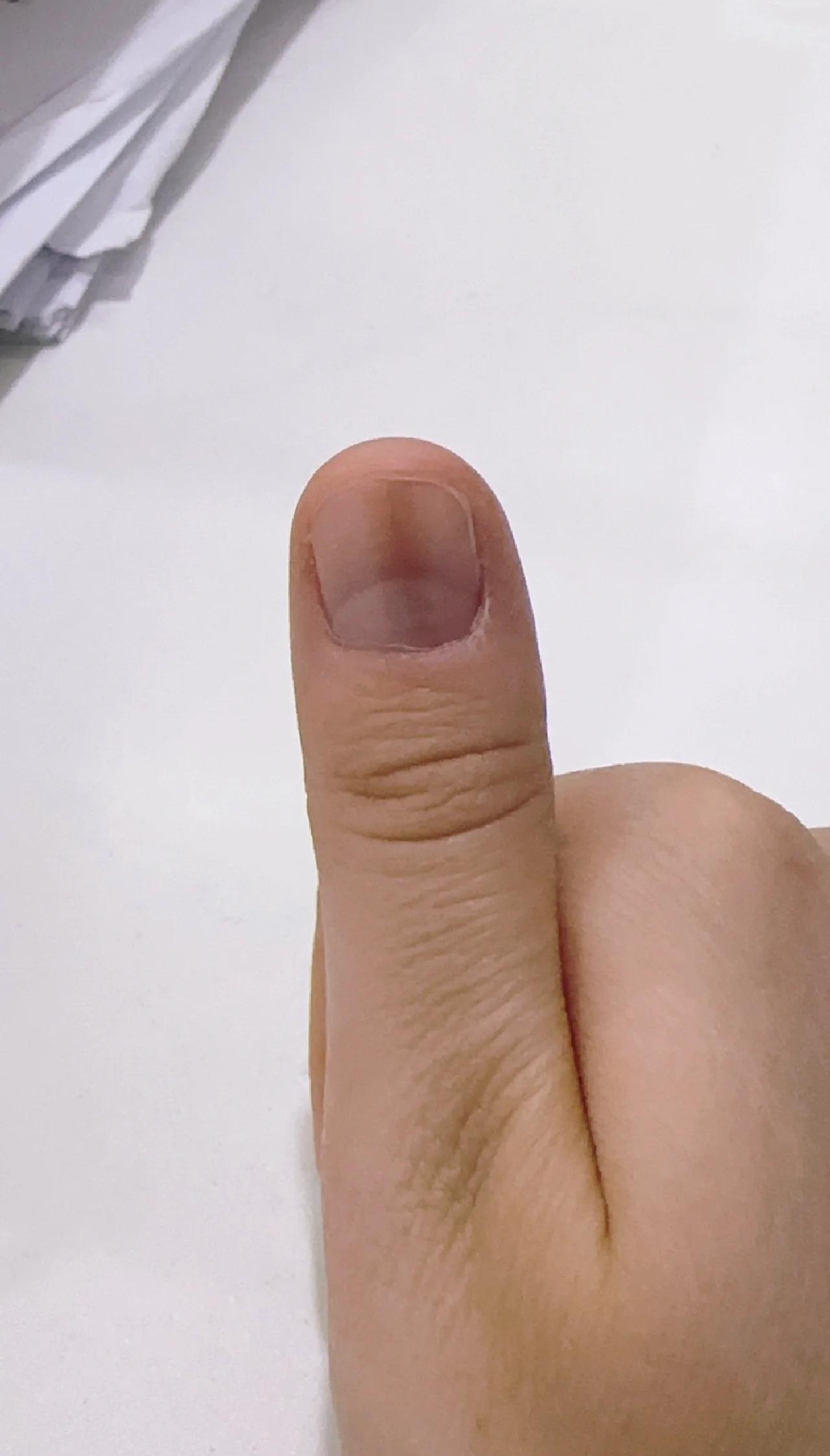 指甲上出现坑坑洼洼的,还有竖纹,怎么回事