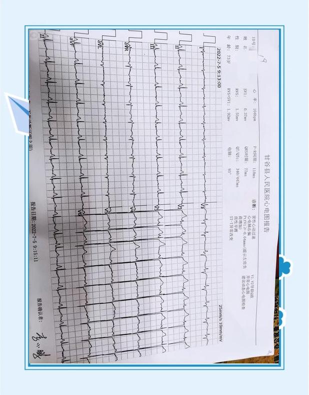 窦性心律不齐会猝死吗