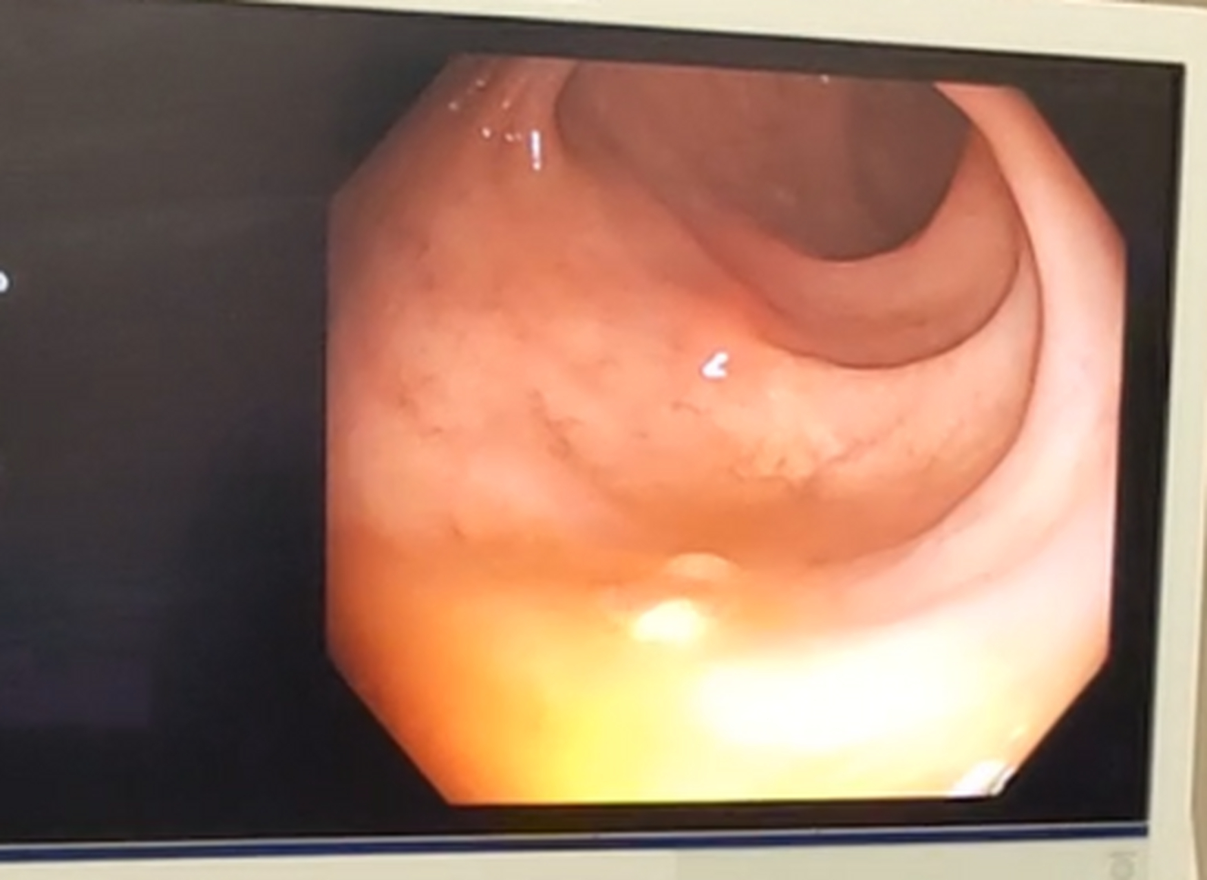 直肠息肉严重吗