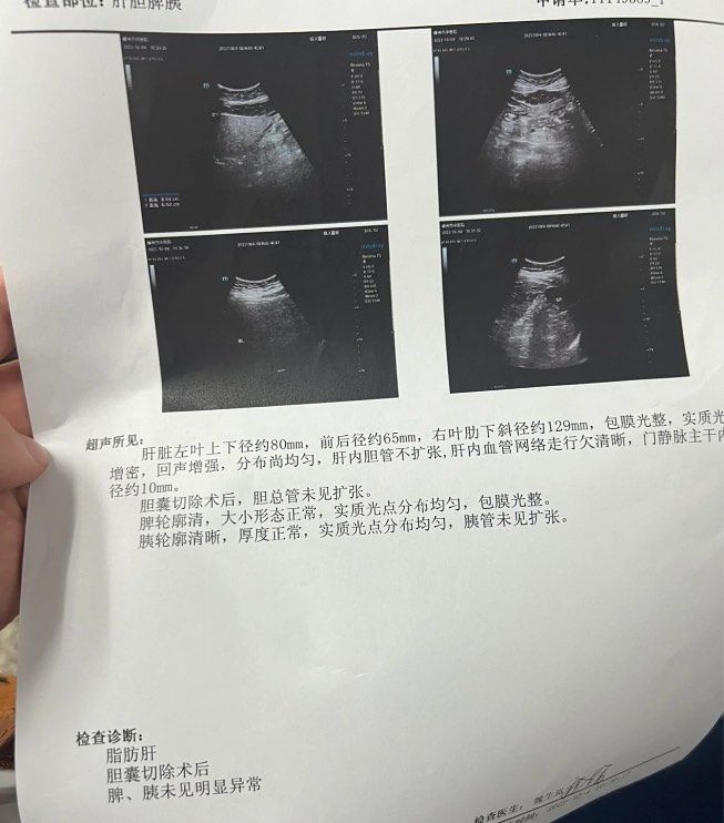 重度脂肪肝症状