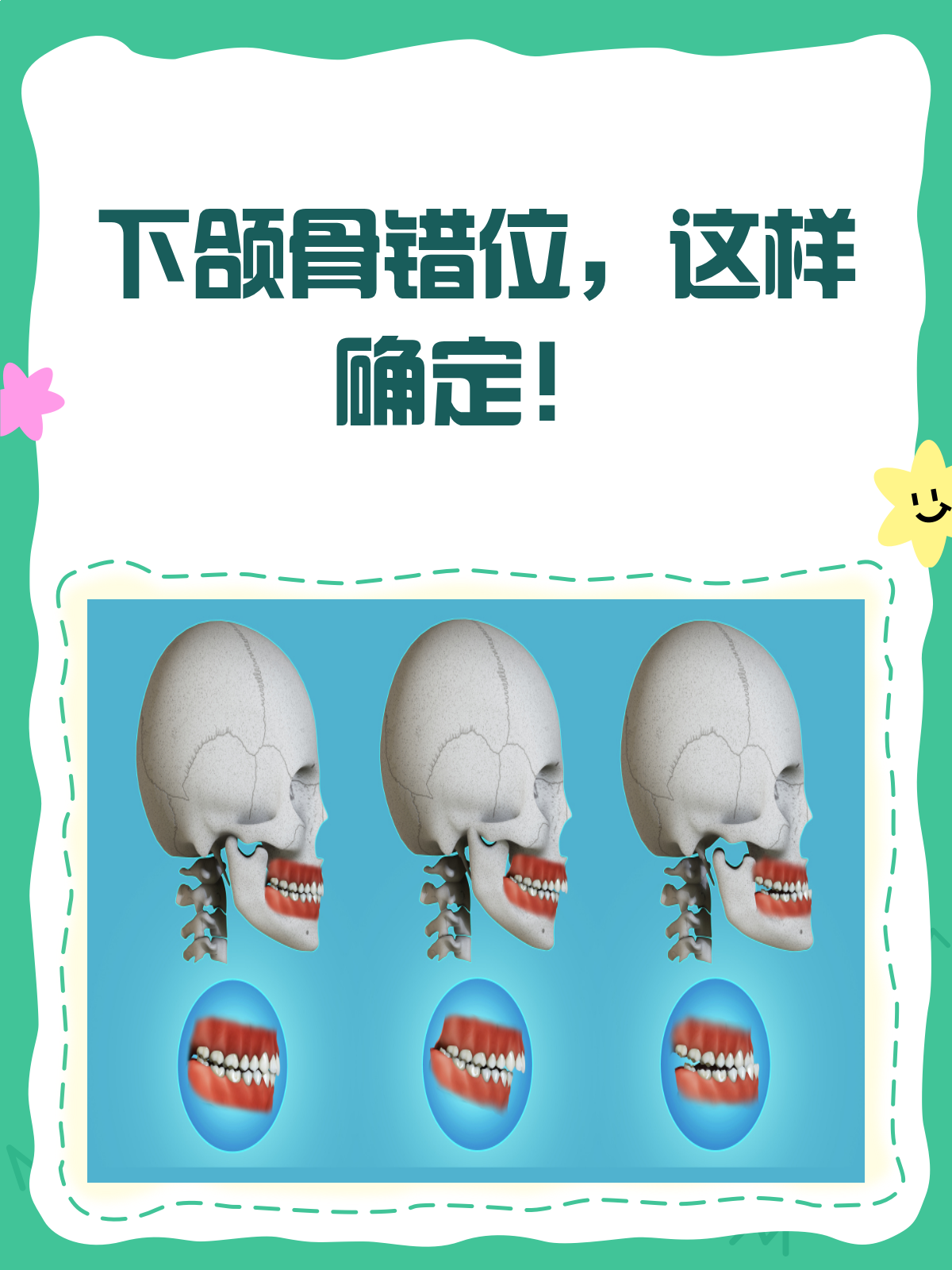 下巴错位会自己恢复吗